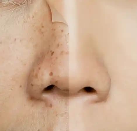 Çil Lekeleri ve Cilt Sağlığı: Güneş Koruma ve Doğal Çözüm Yöntemleri