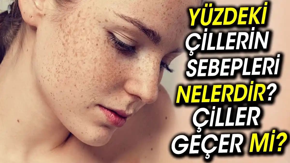 Çillerler Geçer mi Güzellik ve Kozmetik Perspektiften Uzman Görüşleri