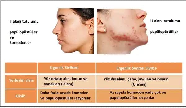 Cilt Aknesi Hakkında Kapsamlı Rehber: Nedenleri, Tedavi Yöntemleri ve Bakım İpuçları