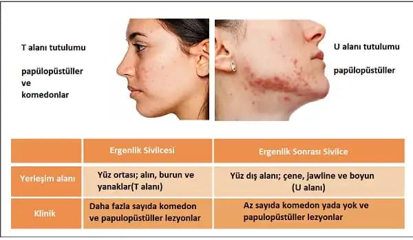 Cilt Aknesi Hakkında Kapsamlı Rehber: Nedenleri, Tedavi Yöntemleri ve Bakım İpuçları
