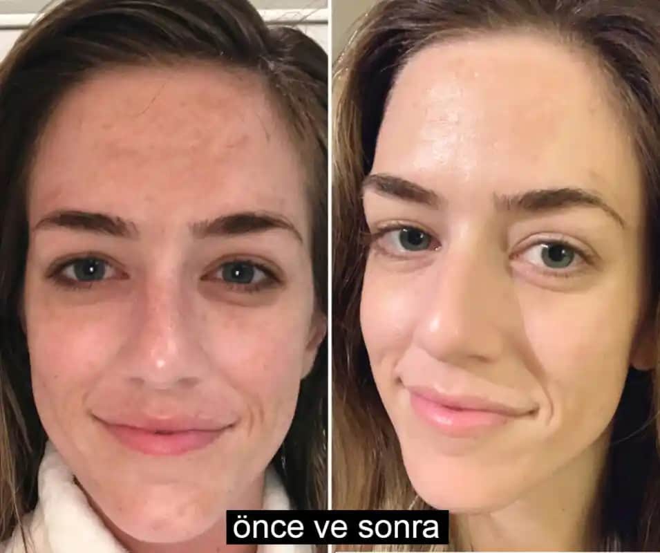 Cilt Bakımı Öncesi ve Sonrası: En İyi Sonuçlar İçin Bilmeniz Gerekenler