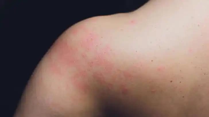 Ciltte Kabarma ve Kızarma Sorunlarının Nedenleri ve Doğal Çözüm Yöntemleri