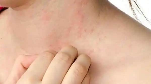 Ciltte Kararma ve Kaşıntı Sorunlarına Karşı Kozmetik Çözüm ve Bakım Tavsiyeleri