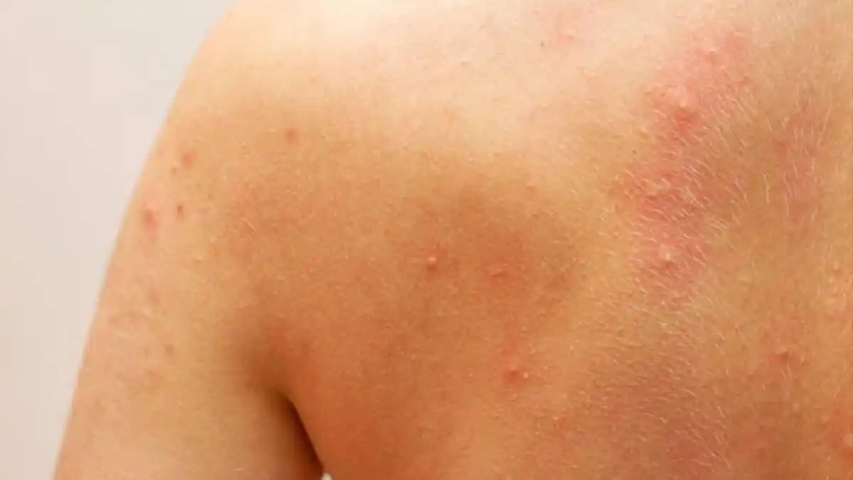 Ciltte Kaşıntı, Kızarıklık ve Kabarmanın Nedenleri ve Etkili Çözüm Yolları