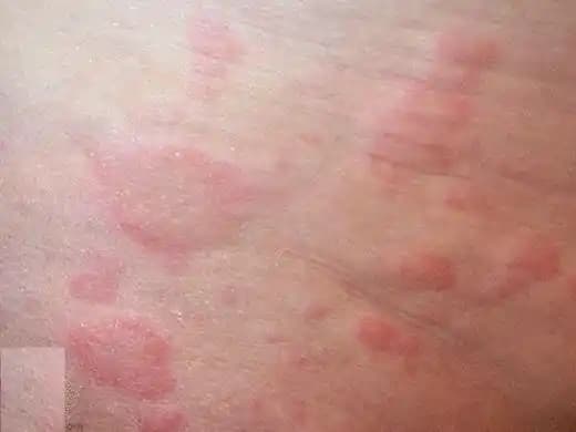 Ciltte Kırmızı Kabarcıkların Nedenleri Belirtileri ve Etkili Çözüm Yolları