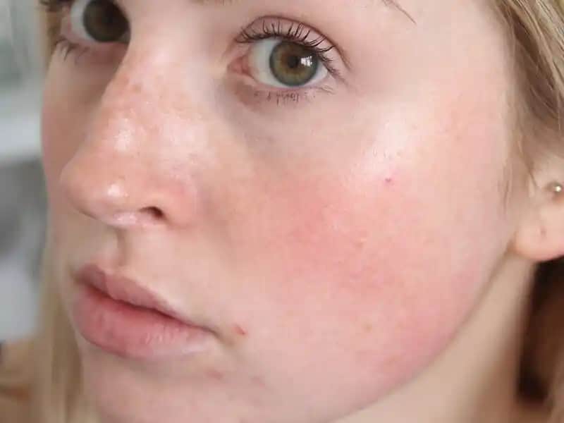 Ciltte Kırmızı Lekelerin Nedenleri, Tedavi Seçenekleri ve Koruyucu İpuçları