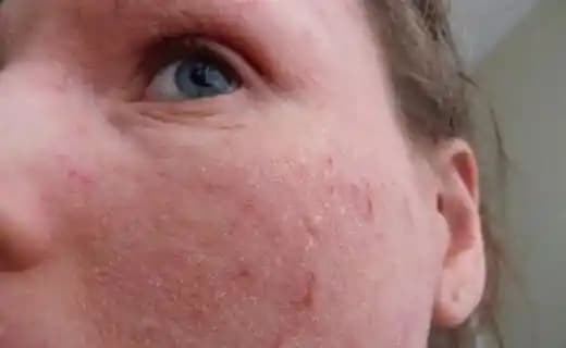 Ciltte Kızarıklık ve Kaşıntı Sorunlarına Karşı Bilinçli Kozmetik Kullanımı Rehberi