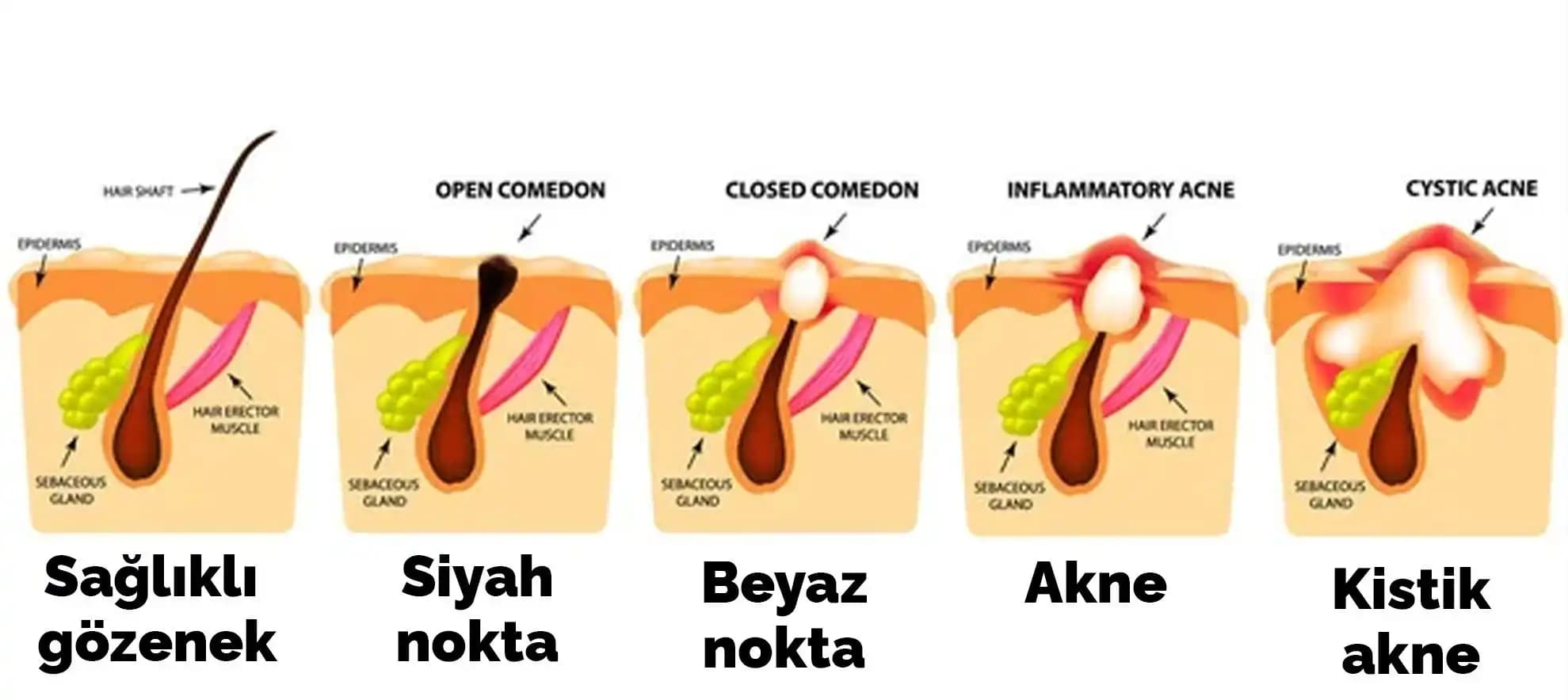 Ciltte Komedonlar: Nedenleri, Türleri ve Etkili Kozmetik Yaklaşımlar