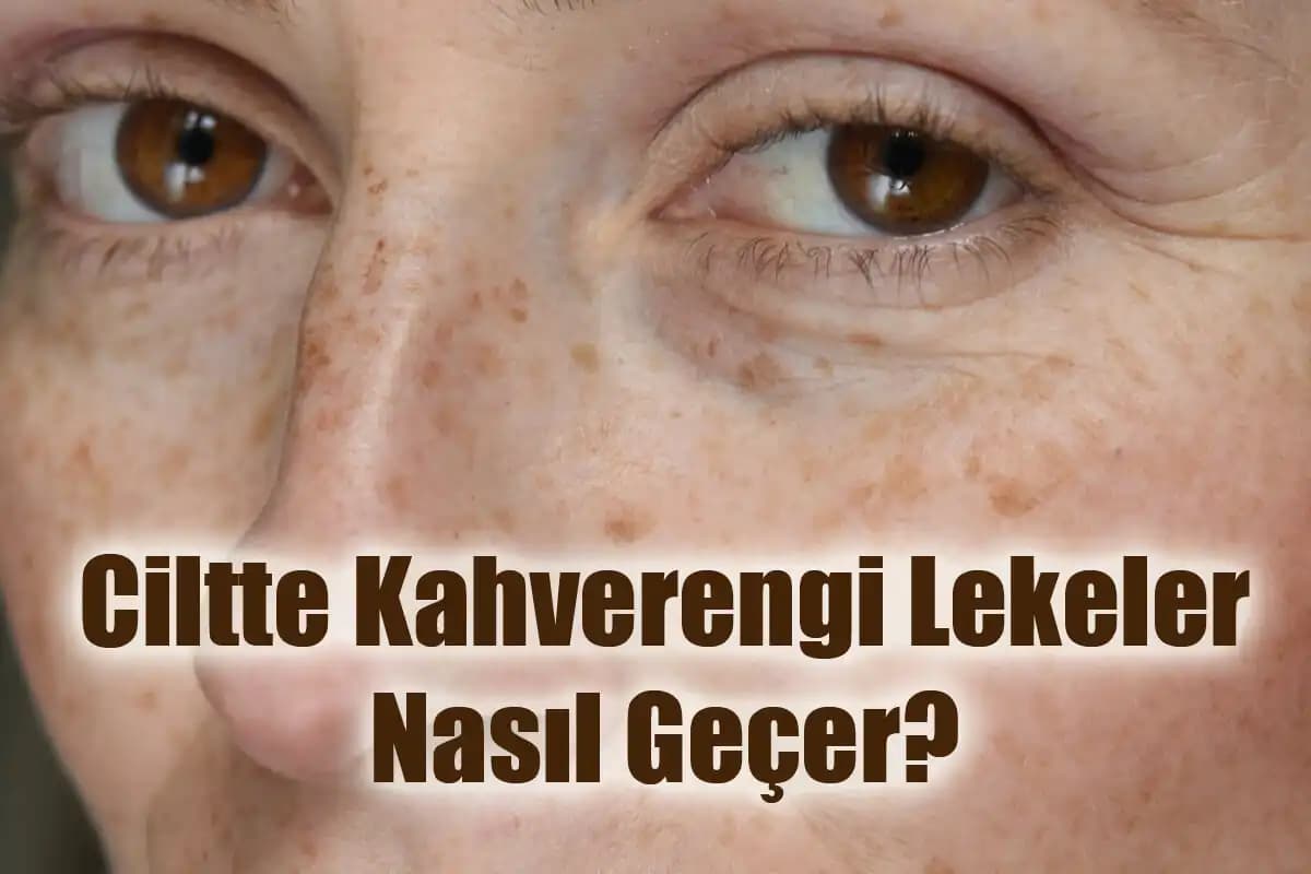 Ciltte Koyu Lekelerle Mücadele Yöntemleri ve Gelişmiş Çözümler