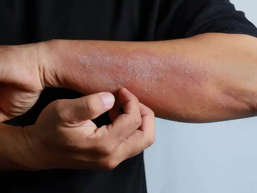 Ciltte Mantar Belirtileri, Nedenleri ve Korunma Yolları Hakkında Detaylı Bilgiler