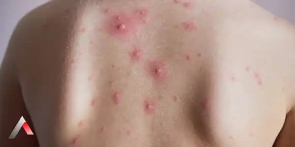 Ciltte Minik Kabarcıklar ve Kaşıntı Nedenleri, Belirtiler ve Korunma Yöntemleri