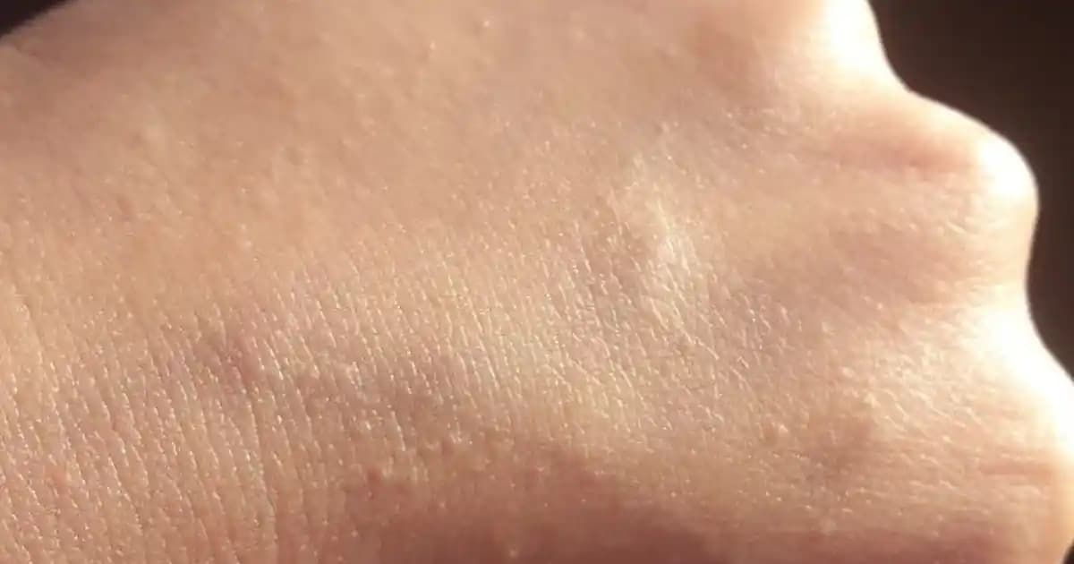 Ciltte Pütürcükler Neden Olur ve Etkili Çözüm Yöntemleri Nelerdir