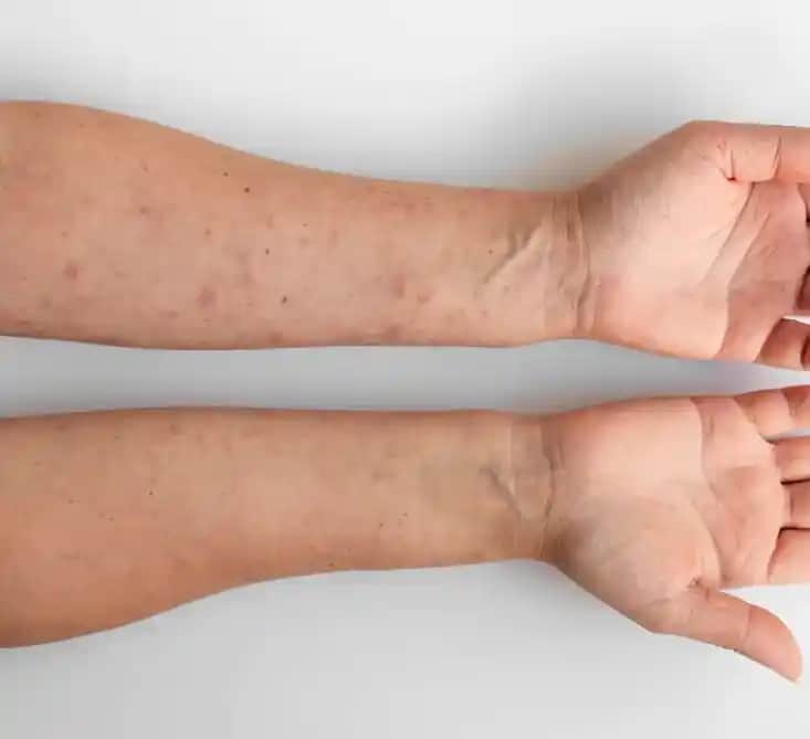 Ciltte Sedef Hastalığına Karşı Kozmetik ve Bakım Yaklaşımlarıyla Sağlıklı Cilt Rehberi