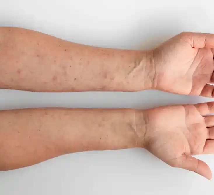 Ciltte Sedef Hastalığına Karşı Kozmetik ve Bakım Yaklaşımlarıyla Sağlıklı Cilt Rehberi