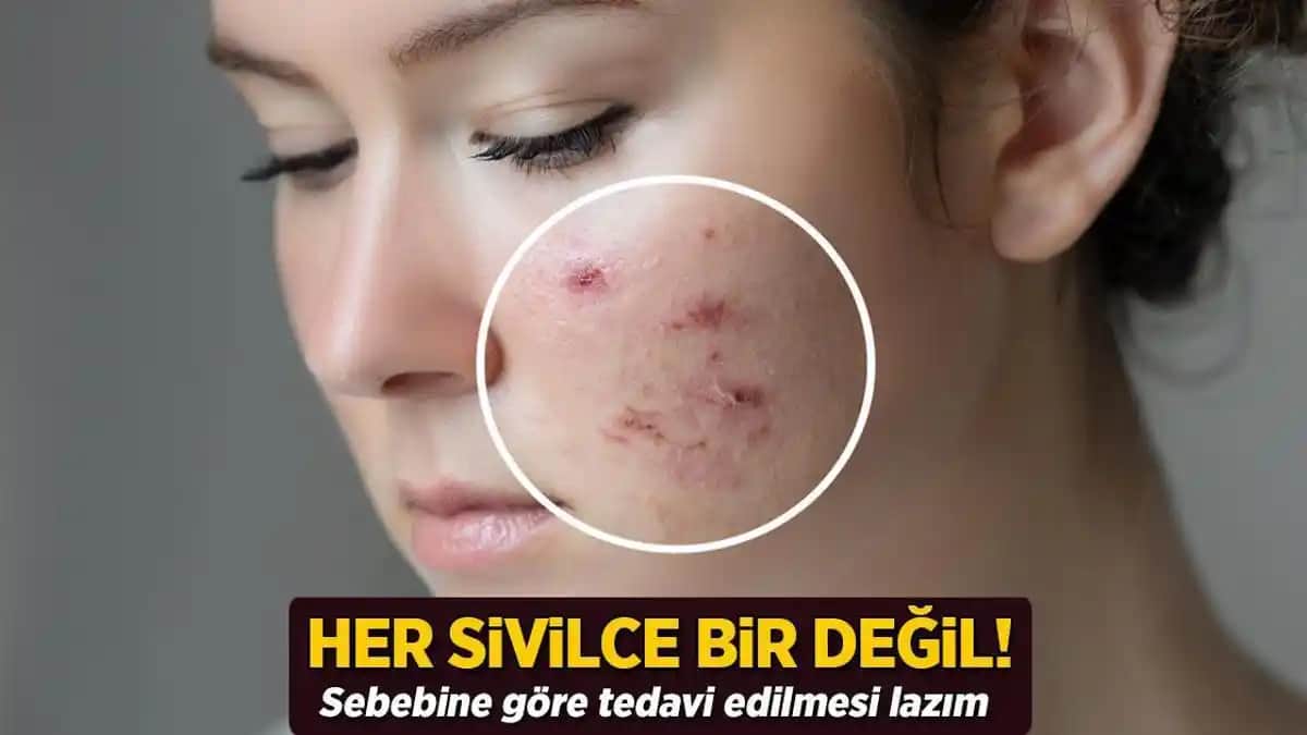 Ciltte Sivilce Gibi Görünen Ama Değil Olan Durumlar ve Tedavi Yöntemleri