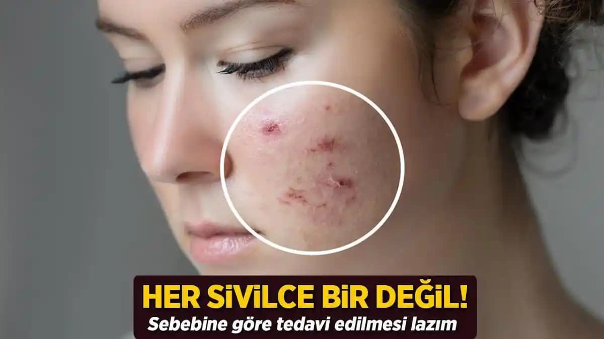 Ciltte Sivilce Gibi Görünen Ama Değil Olan Durumlar ve Tedavi Yöntemleri