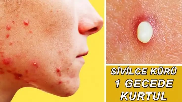 Ciltte Sivilceler: Nedenleri, Etkileri ve Etkili Çözüm Yolları Hakkında Kapsamlı Bilgi