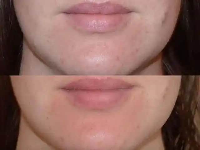 Ciltte Sivilcelere İyi Gelen Asitler ve Doğal Çözümler Hakkında Bilmeniz Gerekenler