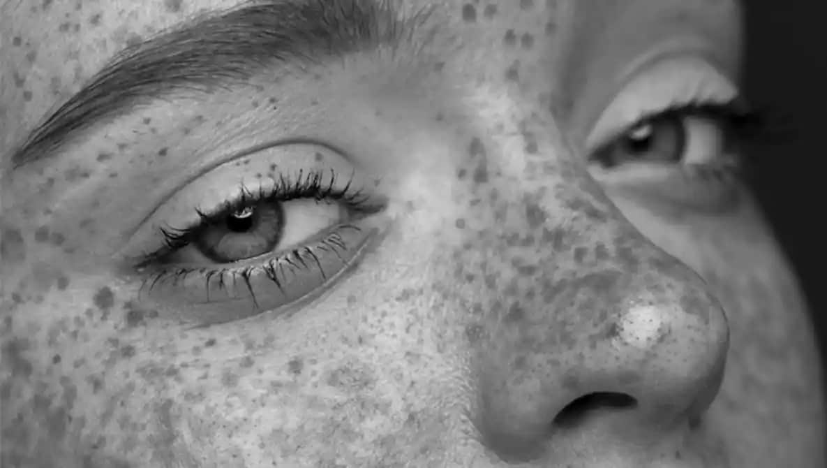 Ciltte Siyah Lekeler: Nedenleri, Çözüm Yöntemleri ve Bakım Tavsiyeleri