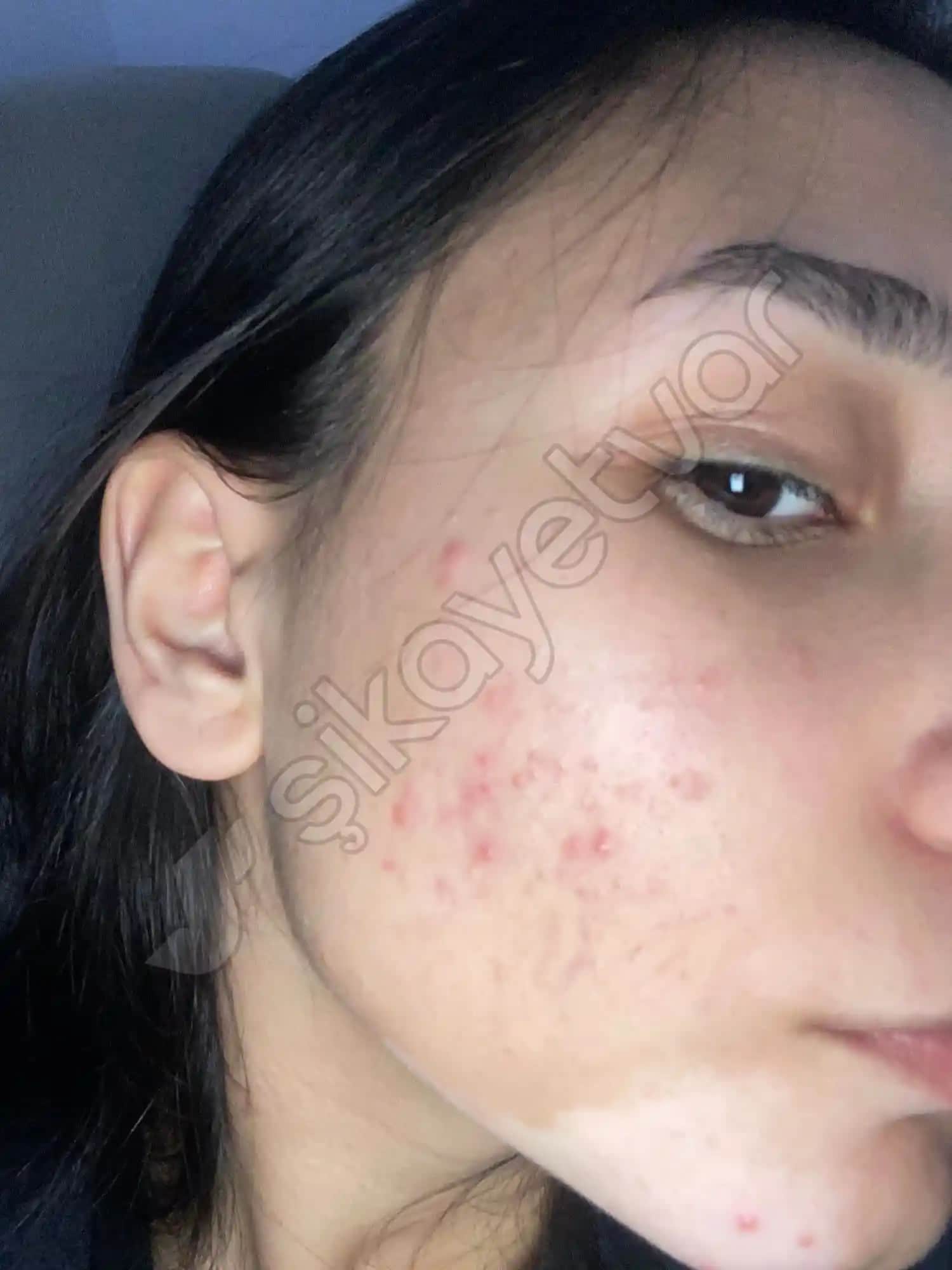 Ciltte Sürekli Sivilce Çıkmasının Nedenleri ve Etkili Çözüm Yolları