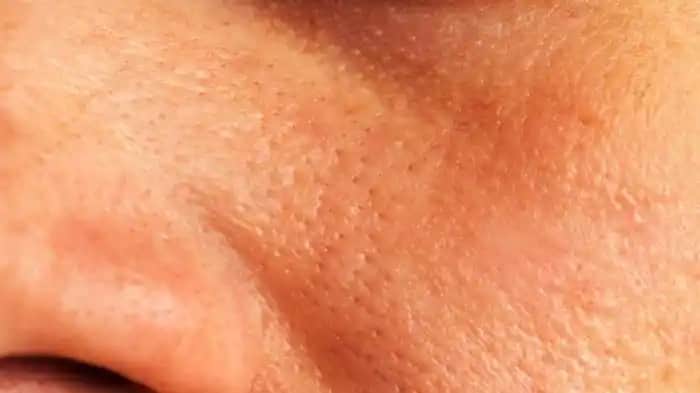 Ciltteki Gözenekleri Yok Etme Yöntemleri ve Doğal Çözümler Rehberi