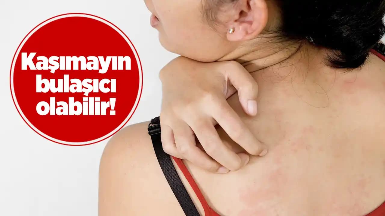 Ciltteki Kabarcıkların Nedenleri, Belirtileri ve Korunma Yöntemleri