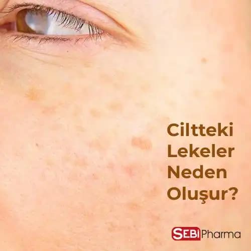 Ciltteki Koyu Lekelerin Nedenleri ve Giderme Yöntemleri Hakkında Kapsamlı Rehber