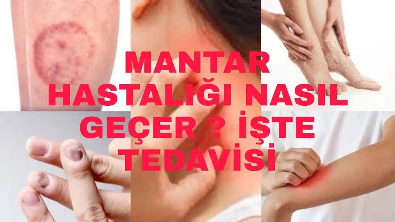 Ciltteki Mantarlar Nedenleri Belirtileri ve Etkili Tedavi Yöntemleri Hakkında Kapsamlı Bilgi