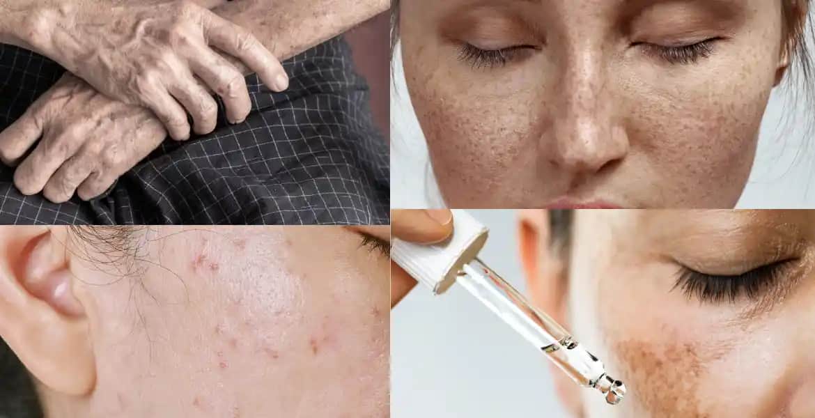 Ciltteki Pigmentasyon Hastalıklarının Nedenleri ve Etkili Tedavi Yöntemleri