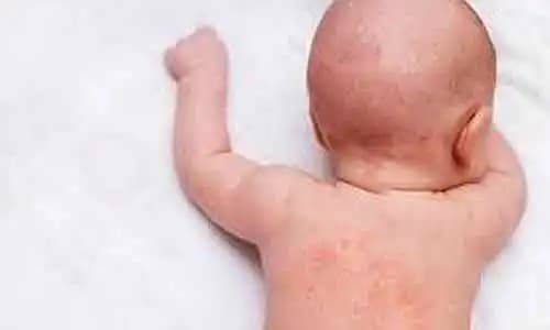 Çocuk Egzaması ve Güvenli Kozmetik Ürünlerle Etkili Cilt Bakımı Rehberi