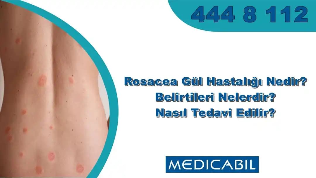 Çocuklarda Gül Hastalığı: Belirtileri, Nedenleri ve Kozmetik Yaklaşımlar