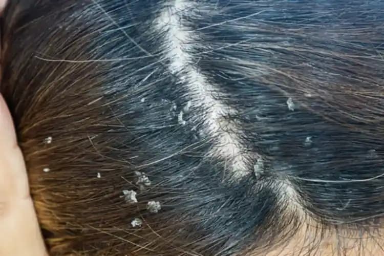 Çocuklarda Saç Egzaması Nedenleri, Belirtileri ve Etkili Tedavi Yöntemleri