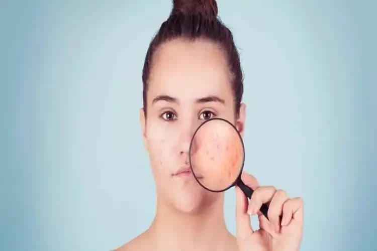 D vitamini eksikliği ve sivilce arasındaki ilişki: cilt sağlığında önemli rolü