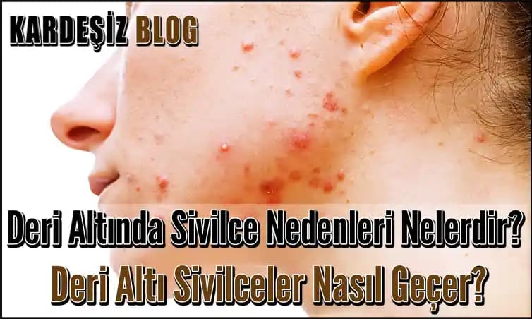 Deri Altı Sivilce Çeşitleri ve Tedavi Yöntemleri Hakkında Kapsamlı Bilgi
