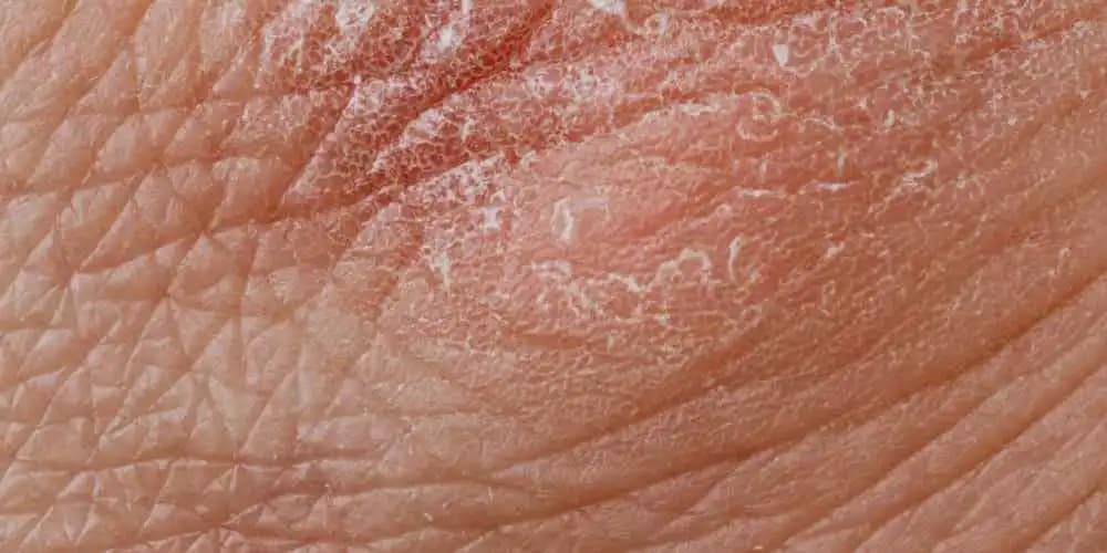 Dermatit Çeşitleri ve Kozmetik Dünyasındaki Yeri: Cilt Sağlığı İçin Bilinmesi Gerekenler