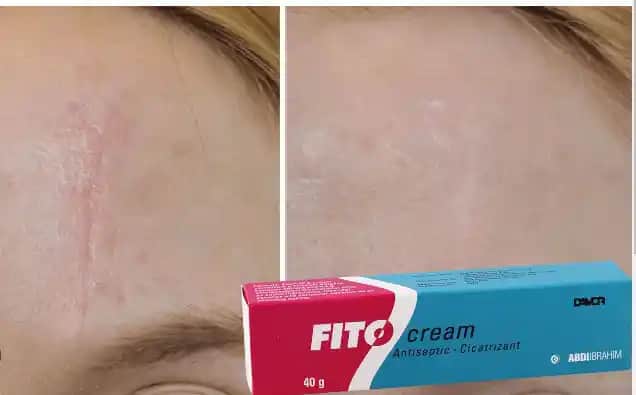 Dikiş Alındıktan Sonra Cilt Bakımı ve Krem Kullanımında En Doğru Yaklaşımlar