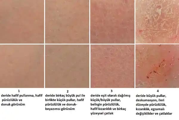 Dikiş Kaşıntısı Nedenleri ve Uygun Bakım Yöntemleri Hakkında Detaylı Bilgi