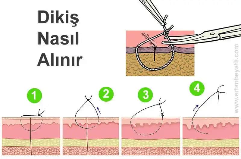 Dikiş Pansumanı Nasıl Yapılır? Adım Adım Detaylı Rehber