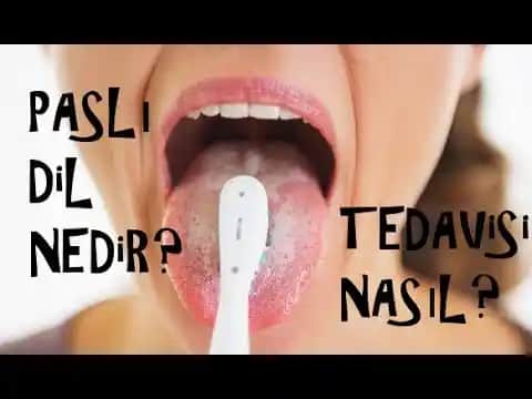 Dil Pası Tedavisi ve Ağız Sağlığını Koruma Yöntemleri