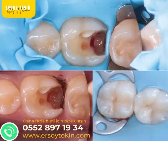 Diş Dolgusu Fiyatları ve Kaliteli Seçenekler Hakkında Bilmeniz Gerekenler