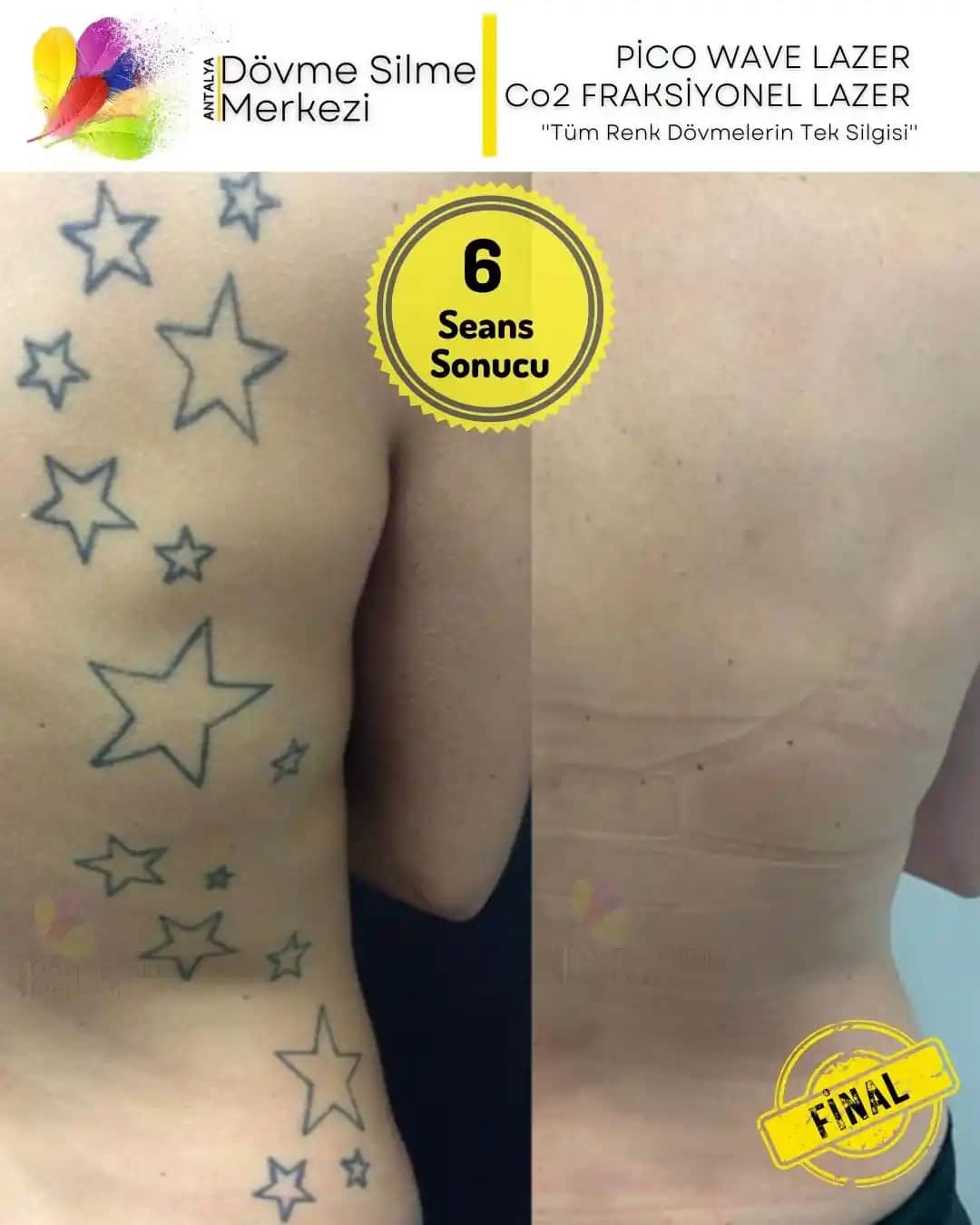 Dövme Silme Sonrası Bakım: Cilt Sağlığı ve Estetik Sonuçlar İçin Öneriler