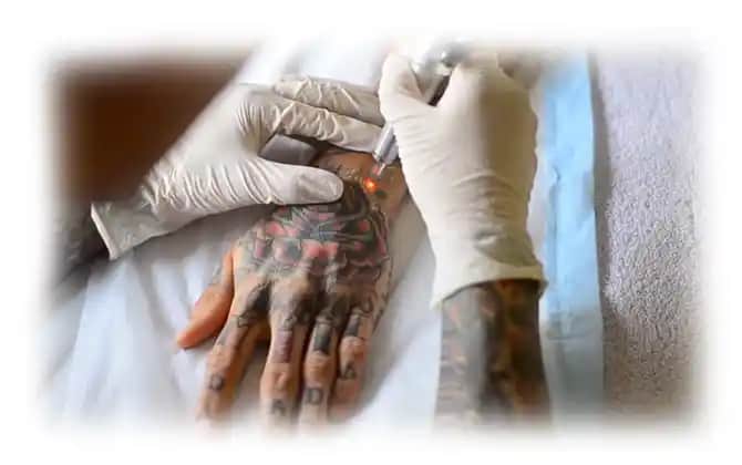 Dövme Yarası ve İzleri: Doğru Bakım ve Estetik Çözümlerle Cilt Sağlığını Koruma