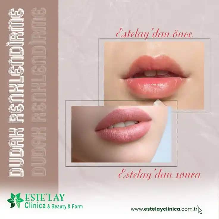 Dudak Çerçevesi Nedir ve Makyaj ile Estetik Uygulamalarda Nasıl Kullanılır