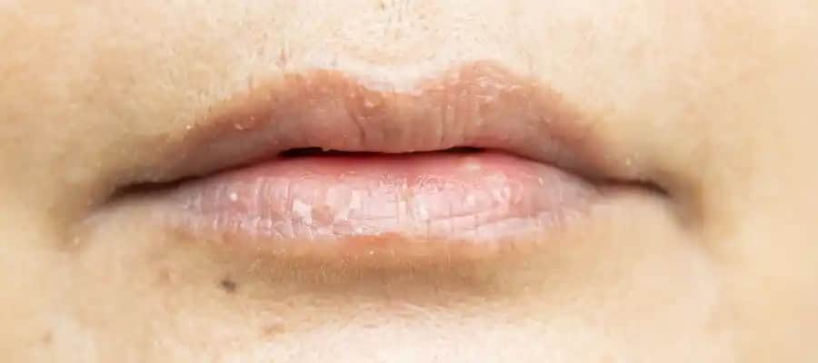 Dudak Kararmasının Nedenleri ve Doğal Çözüm Yöntemleri Hakkında Kapsamlı Rehber