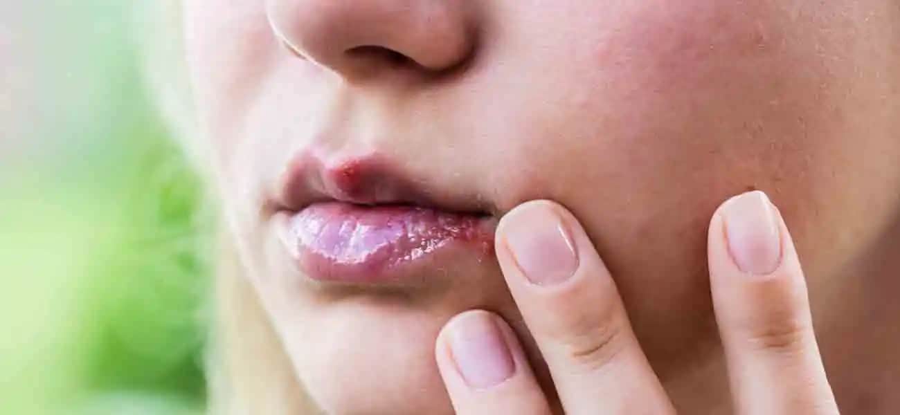 Dudak Kaşıntısının Nedenleri ve Doğal Çözüm Yöntemleri hakkında Kapsamlı Bilgi