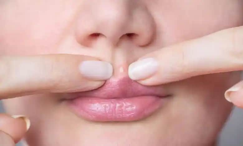 Dudak Kenarında Sivilce Nedenleri ve Etkili Çözüm Yöntemleri Rehberi