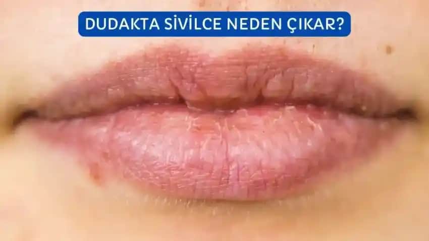 Dudak Kenarında Siyah Nokta Nedenleri, Çözüm Yolları ve Bakım İpuçları