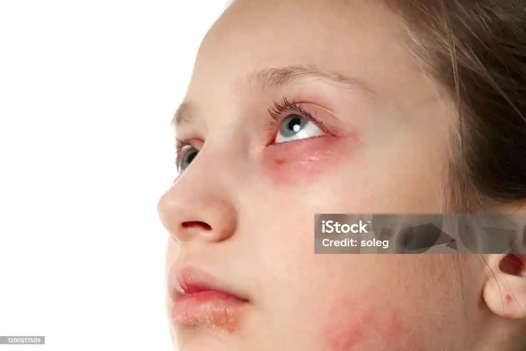 Dudaklarda Kızarıklık Nedenleri ve Sağlıklı Dudaklar İçin Bakım İpuçları