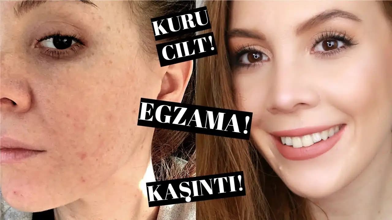 Egzama Atağı ve Kozmetik Ürünlerle Cilt Bakımında Dikkat Edilmesi Gerekenler