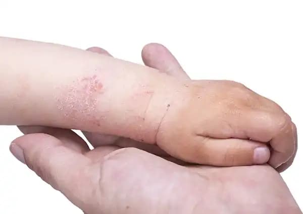 Egzama Başlangıcı ve Doğru Müdahale Yöntemleri Hakkında Kapsamlı Bilgi